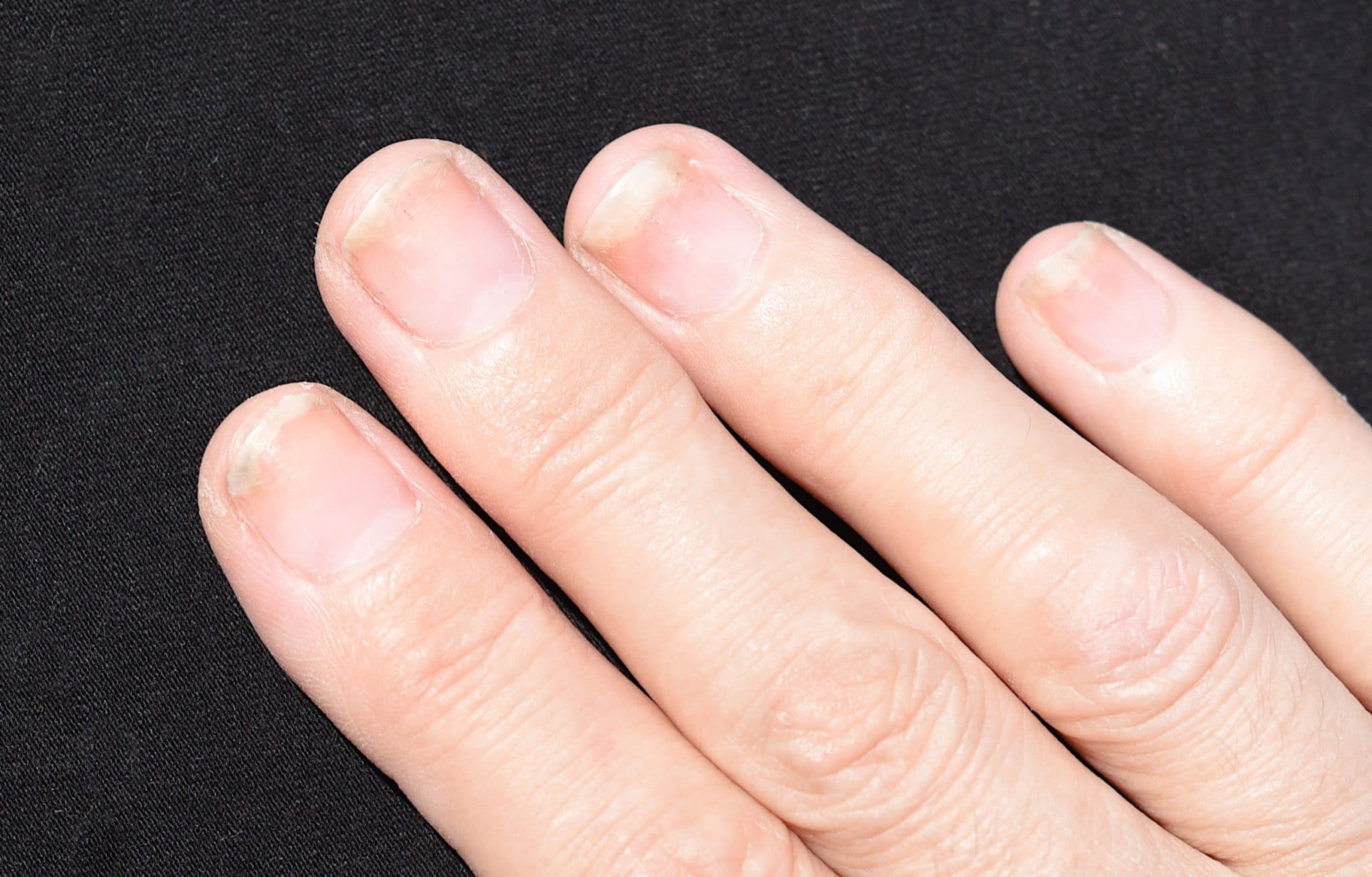 Ongle décollé : astuces pour soigner mycose et choc