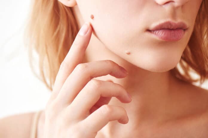 Comment surveiller ses grains de beauté ?