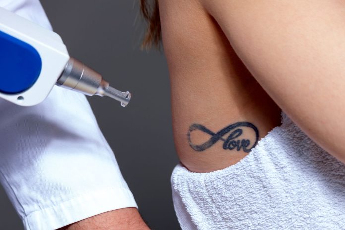 enlever tatouage fait avec son ex