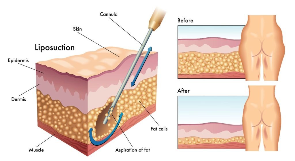 fonctionnement liposuccion